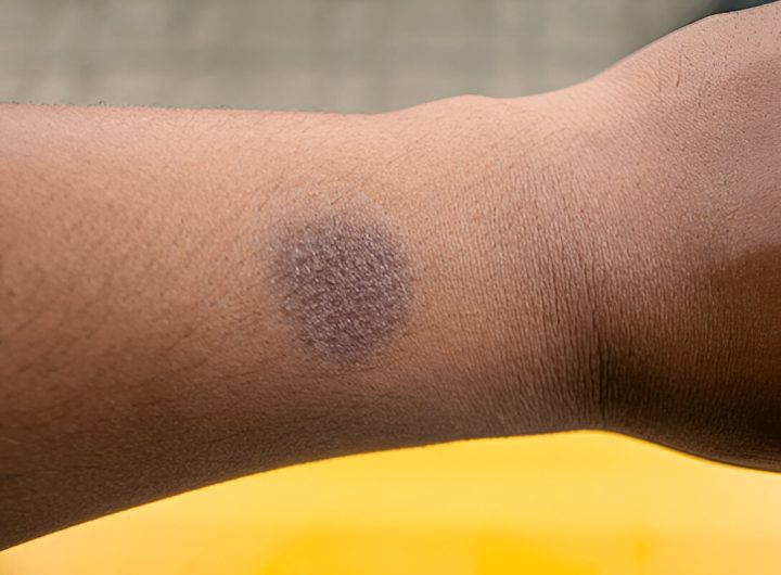 Luka bakar menghitam di tangan akibat penggorengan panas (shutterstock.com)